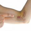 Vết bầm tím kèm xuất huyết tự nhiên xuất hiện trên da, có đáng lo?
