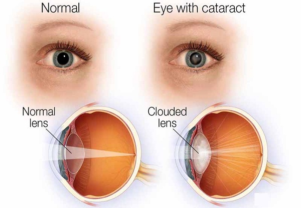 thuốc Acetylcholine là một loại thuốc dành cho mắt được sử dụng để làm co đồng tử mắt sau khi phẫu thuật đục thủy tinh thể hoặc sau một ca phẫu thuật mắt