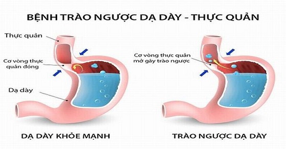 Trào ngược dạ dày thực quản
